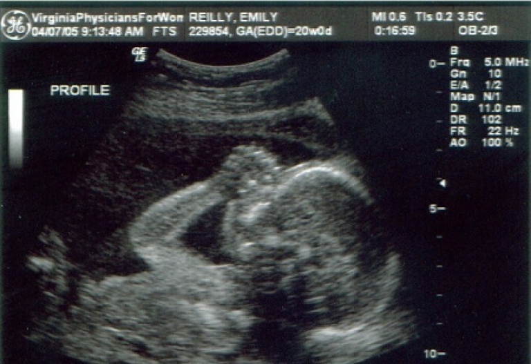 Мальчик 20 недель беременности. Снимок УЗИ плода 20 недель. Снимки УЗИ на 20 неделе беременности. УЗИ плода на 22 неделе беременности. 20 Недель беременности фото плода на УЗИ.
