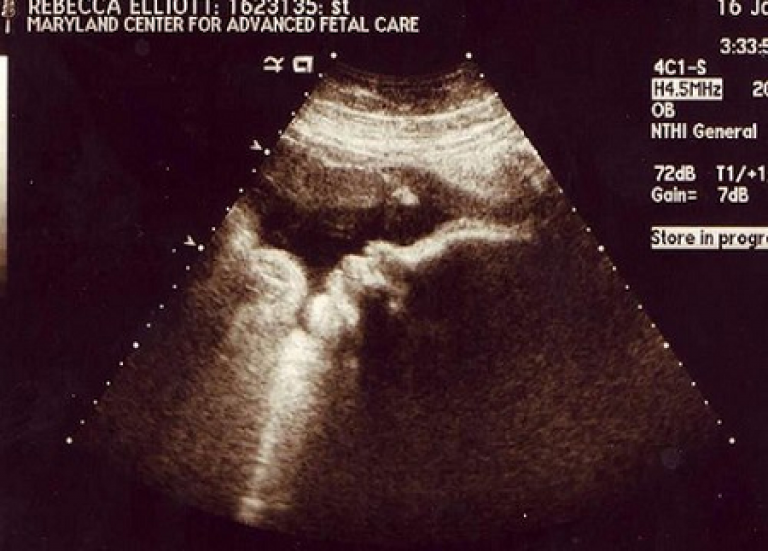 УЗИ беременности на поздних сроках. 37 недель мальчик