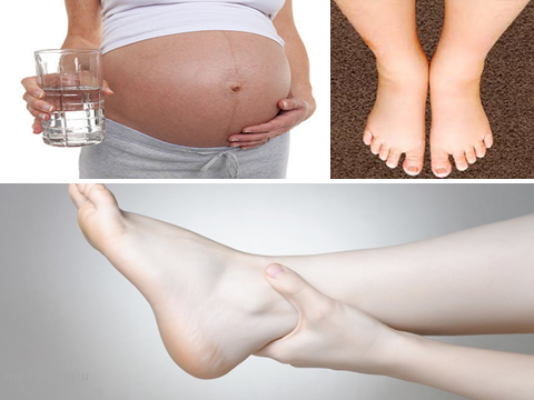 Отеки ног третий триместр. Водянка беременных гестоз.