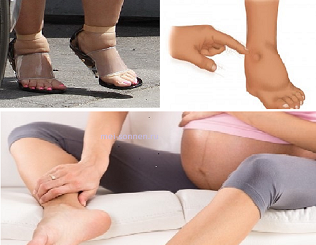 Отекла нога при беременности 3 триместр. Отекание ног при беременности. Отёки при беременносьи.