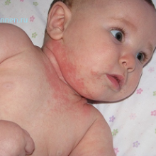 Аллергия у детей — что делать, как помочь ребенку?