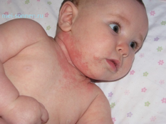Аллергия у детей — что делать, как помочь ребенку?