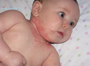 Аллергия у детей - что делать, как помочь ребенку?
