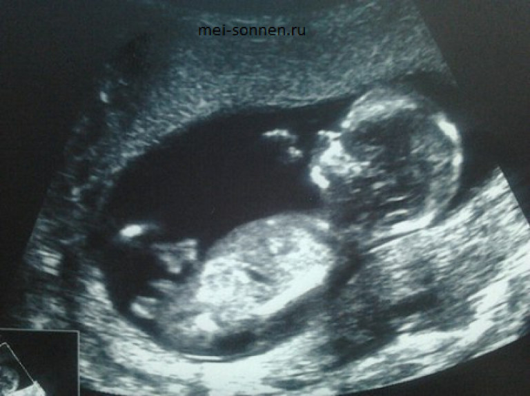 Беременность 13 мм. Ребенок на 13 неделе беременности УЗИ. Эмбрион на 13 неделе беременности УЗИ. 13 Недель беременности фото плода на УЗИ. Эмбрион 13 недель беременности фото УЗИ.