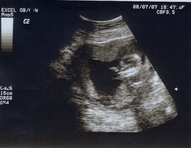 Беременность 14 недель отзывы. Фото ребёнка в животе 12 13 14 неделя беременности от зачатия. У ребенка в 14 недель 1:68 тримасома 18. Если на соре 14 недель.