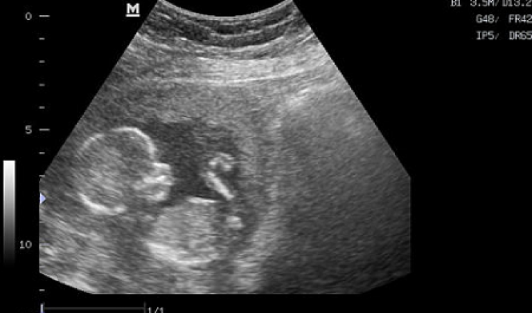 15 неделя беременности фото узи