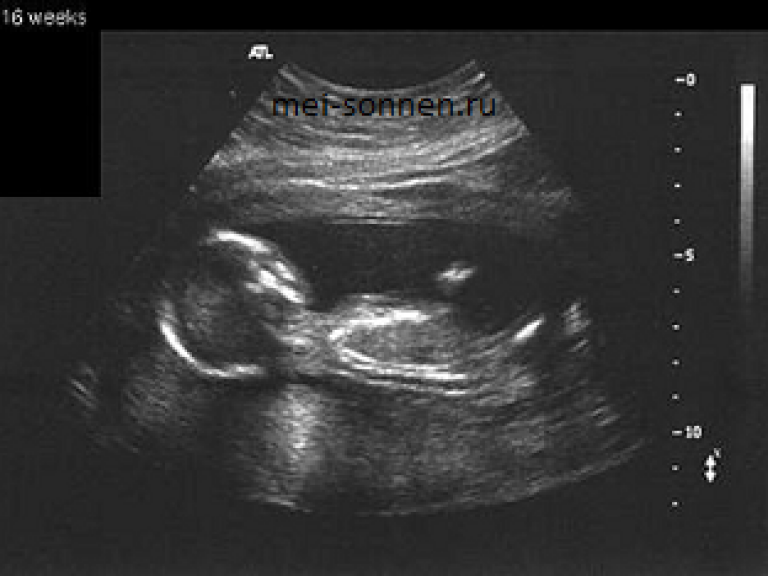 17 недель развитие. Малыш на 16 неделе беременности УЗИ. УЗИ ребенка на 17 неделе беременности. УЗИ 17 недель беременности фото. УЗИ ребенка на 16 неделе беременности.