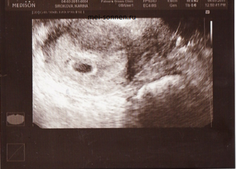 Фото узи на 5 неделе. Снимок УЗИ на 5 неделе беременности. Снимки УЗИ на 5 неделе беременности. 5 Недель беременности фото плода на УЗИ. Плод на 5 неделе беременности УЗИ.