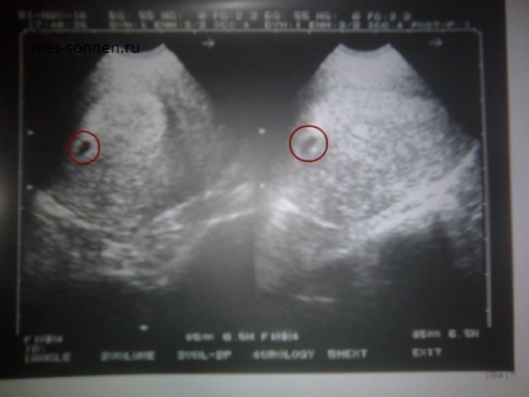 Снимок УЗИ беременности. УЗИ беременности на ранних сроках.