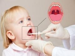 Ангина у детей: как и чем лечить детское горлышко?