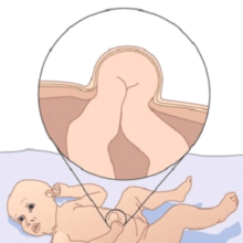 Диагностика и лечение грыжи пупочного канатика у новорожденных