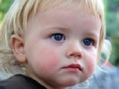Диатез на щеках у ребенка – лечение