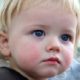 Диатез на щеках у ребенка – лечение