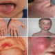 Как лечить инфекционный мононуклеоз у детей?