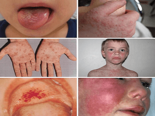Как лечить инфекционный мононуклеоз у детей?