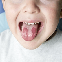 Стоматит у детей: причины, симптомы и лечение