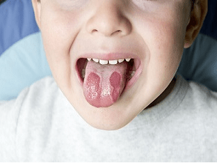 Стоматит у детей: причины, симптомы и лечение