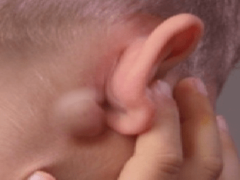 Что делать если за ухом появилась шишка