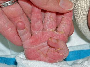 Почему у ребенка облазит кожа на пальцах рук