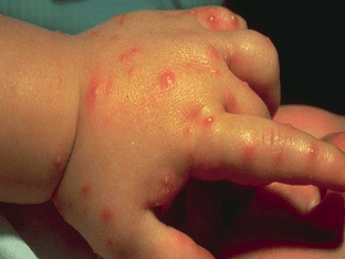 Что делать, если ребенка покусали комары?