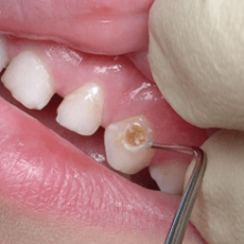 Лечить ли молочные зубы у ребенка?