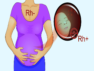Отрицательный резус фактор при беременности