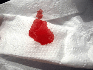 Почему бывают кровотечение при беременности