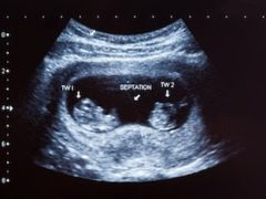 Многоплодная беременность по неделям узи и причины ее возникновения, особенности вынашивания